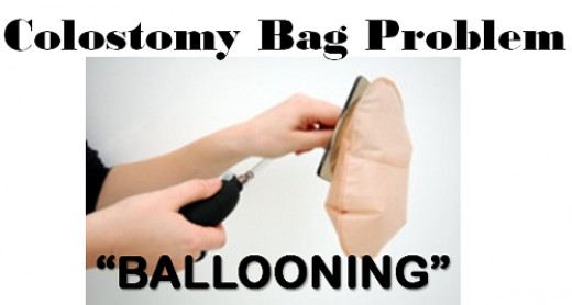 Image result for ostomy ballooning