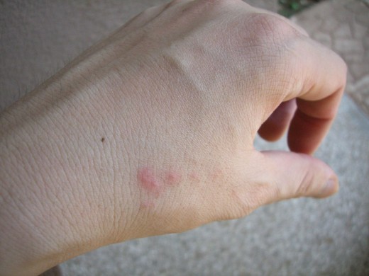 Is it a rash? No, it's a cluster of bed bug bites. | Source