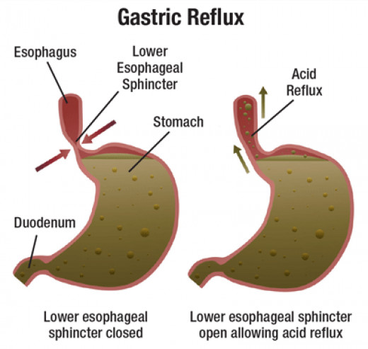 Acid Reflux Symptoms,Causes and Remedies | HubPages