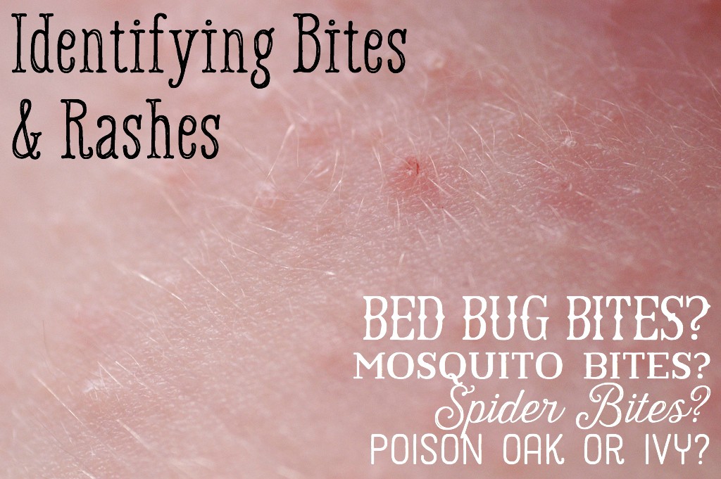 Mosquito Bed Bug Spider Bite Differences Healdove