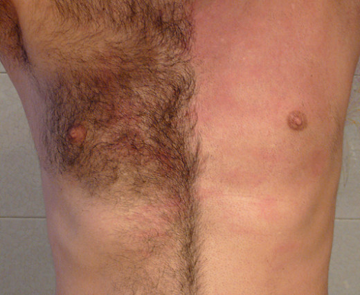 Side by side contrast of the unwaxed chest and the waxed.  Note the temporary inflammation.  There will be some inflammation after your laser treatment, however after your treatments are finished, you will not have to go through this every few weeks.