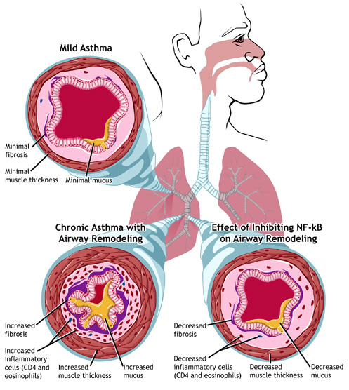 Asthma - Mild and Chronic