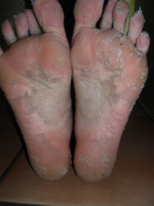 A DIY Peel for Dry, Cracked Feet A DIY Peel for Dry, Cracked Feet