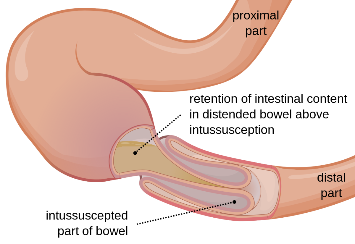 Image result for intussusception in dogs diagram