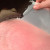 The photo depicts a sunburn suffer. After this person applied Aloe Vera to his or her skin, it starts to peel and you feel relief from the burn. The redness would disappear soon.
