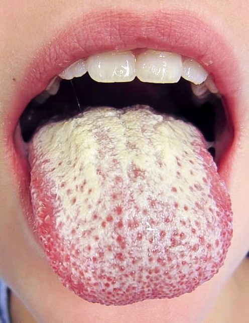 Nystatin: An Antifungal Medicine for Candida Infections Nystatin: An Antifungal Medicine for Candida Infections