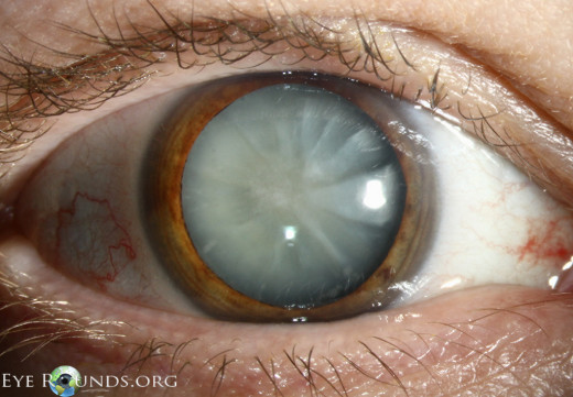 The cloudy Center Represents a Cataract    (not to be confused with a Rincoln)