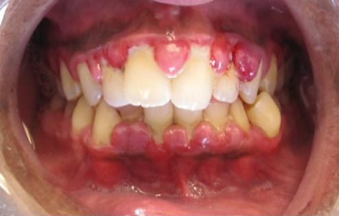 Bacterial dental diseases can be spread during kissing