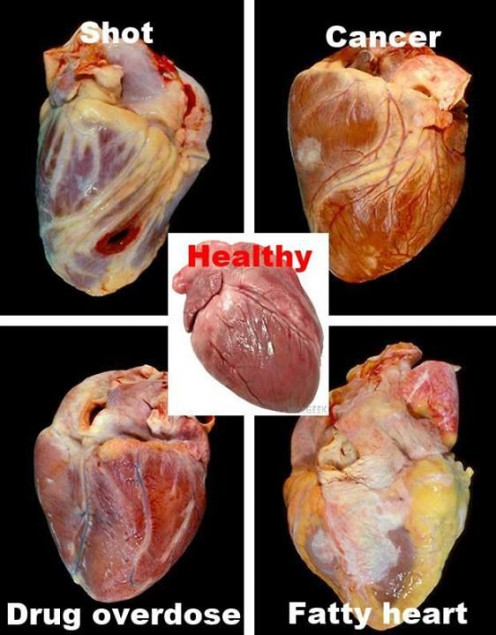 Pathology of the HEART - The Cardiovascular System | hubpages