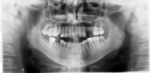 mouth radiography