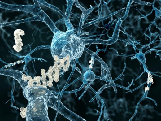 Beta-Amyloid Plaques in the Brain. If you hover over this picture an i will appear. Click on that for source of picture and article on this from Medical News Today.