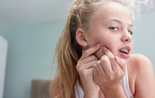 Avoid popping pimples.