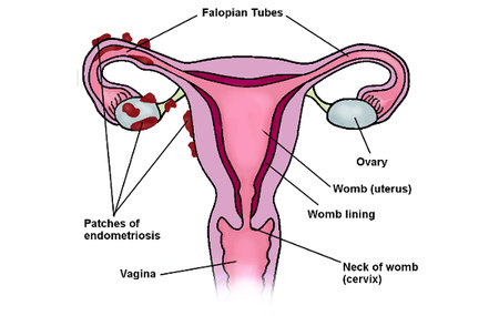 This is a drawing of what a uterus affected by endometriosis might look like