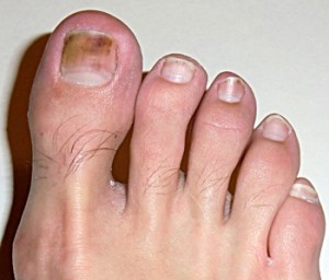 Discolored toe nails due to fungus
