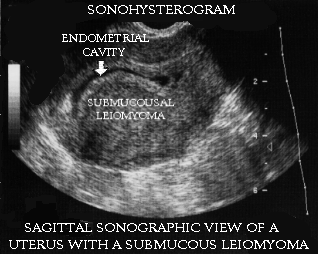Sonohysterogram of a uterus with submucosal myoma