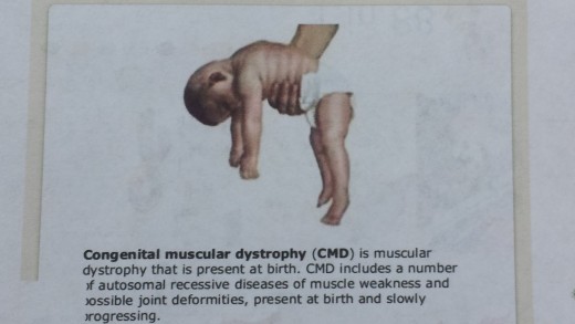 Many Types Of Muscular Dystrophy