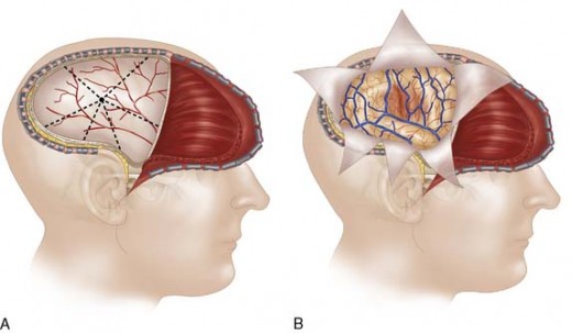 Trauma Flap 12-6