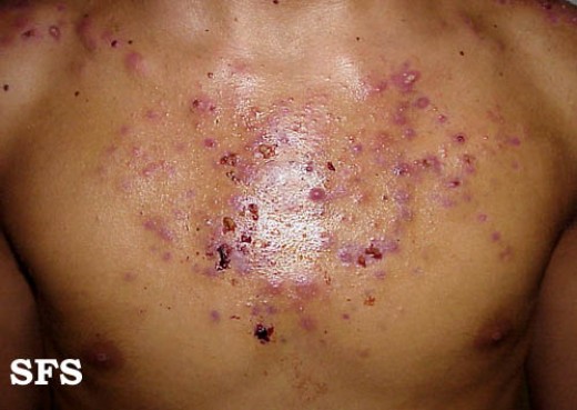 What Causes Pimples on the Chest? HubPages