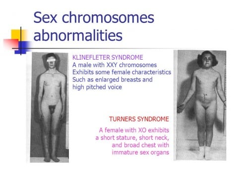 Sex Chromosomes Abnormalities