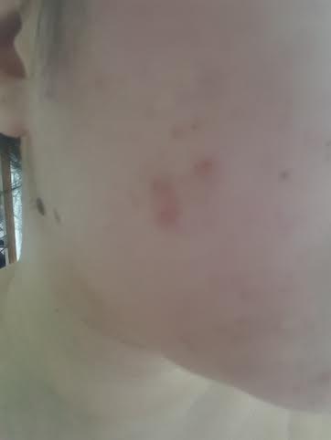 the acne on my cheeks