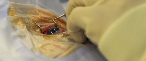 Detached Retina Symptoms: A Patient's Point of View Detached Retina Symptoms: A Patient's Point of View