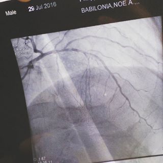 One of the X-rays or dad's heart last July 29, 2016.