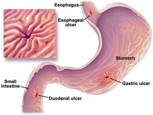 Diagram of stomach ulcers