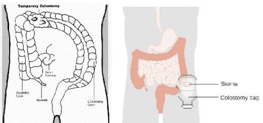 Temporary Colostomy And Stoma Reversal Procedure | HubPages