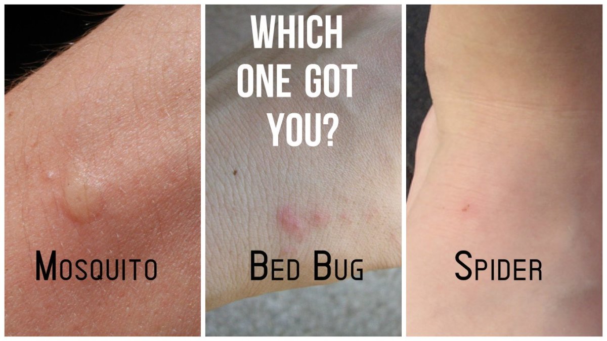 Bed Bugs Bites all over the Body, Recognize and Treat!
