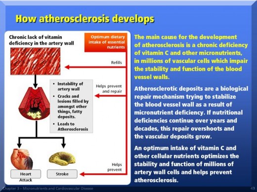 How atherosclerosis develops