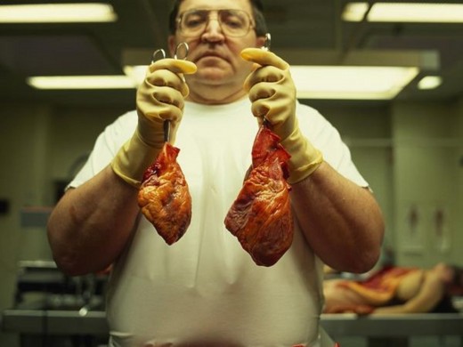 Martti Tenhu, chief medical examiner in Helsinki, Finland, illustrates the differences between a normal human heart and one enlarged by alcoholism and high blood pressure. Covered in scar tissue, the enlarged organ is nearly twice the normal size. Su