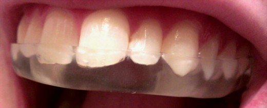 Place the mouth guard accordingly to get the perfect fit.