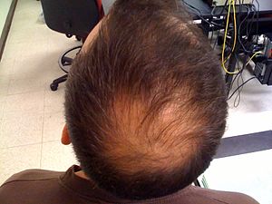 Alopecia, baldness on the  back of a man's head.