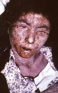 Smallpox (Short Story No. 27)
