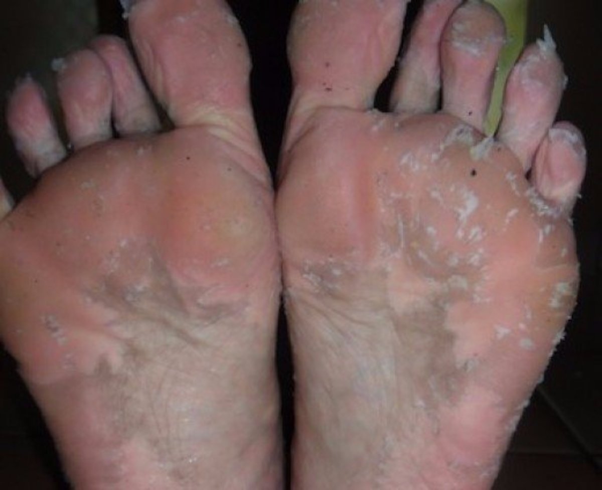 dry skin peeling off feet
