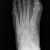 Post-operative radiograph. Lisfranc injuries are complicated injuries characterized by ligament tears, fractures, and the dislocation of bones in the midfoot. Post-operative radiograph. Lisfranc injuries are complicated injuries characterized by ligament tears, fractures, and the dislocation of bones in the midfoot.
