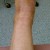 Surgical site Surgical site