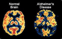 Alzheimer's and Dementia as an Outsider