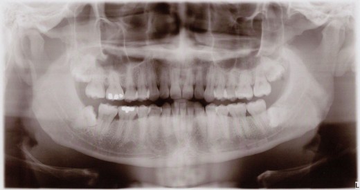 X-ray of mouth shows damage from clinching and grinding. 