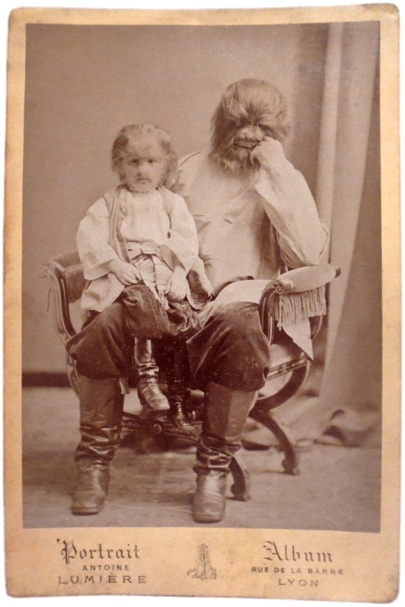 Fedor Jeffichew was known by the stage name JoJo the Dog-Faced Boy and performed with his father who also suffered from hypertrichosis as a curiosity in circuses.