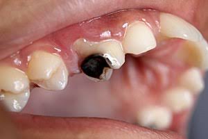 Decaying tooth.