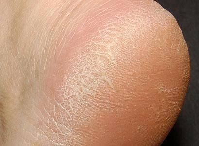 Find out how to fix cracked heels and why your heels dry out and crack in the first place