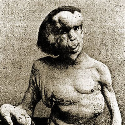 Joseph Merrick, the real Elephant Man.