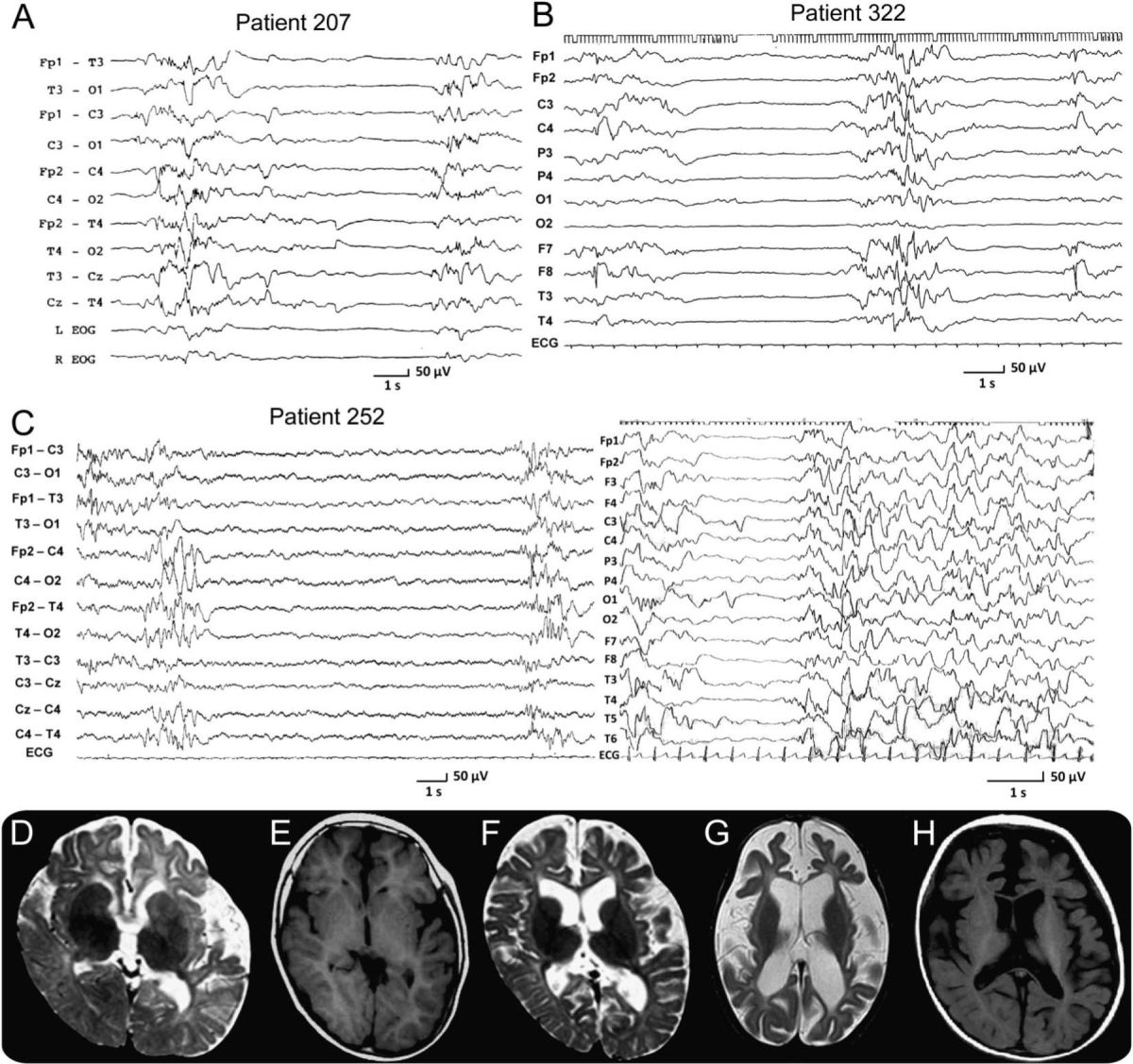 Abnormal EEG's showing spike-wave pattern