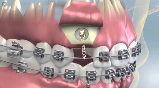 I’ll have gold chains and my own teeth so it’s a win win for me 