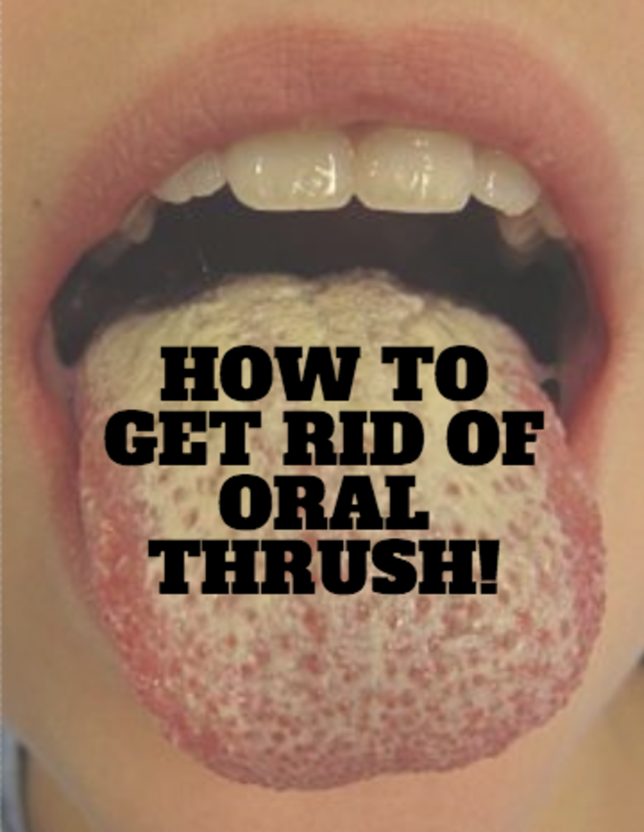 thrush oral rid treat methods battle remedies