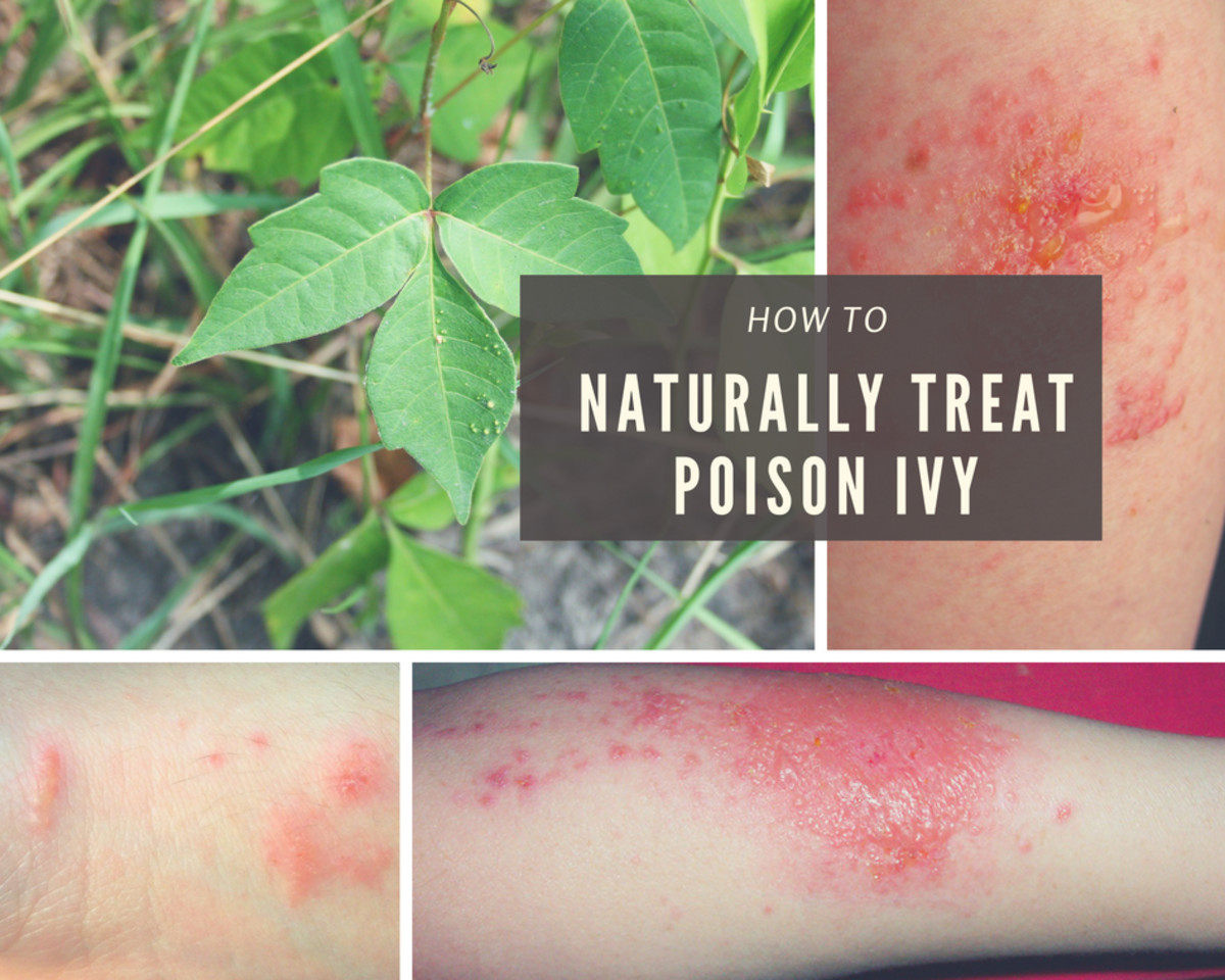 A Natural And Fast Poison Ivy Cure Remedygrove