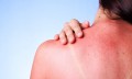 Solutions for Sunburns