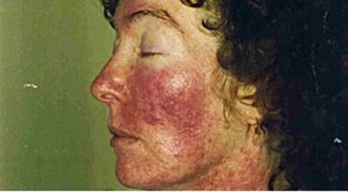 UV radiation rash caused by CFL exposure