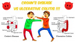 Managing Ulcerative Colitis